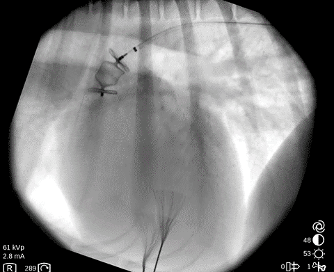 Closure of an atypical patent ductus arteriosus using an AVP-II plug ...